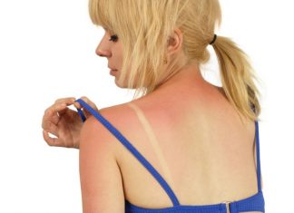 Sunburn Treatment How to Treat Sunburn Skin