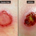 What is MRSA Staph Infection