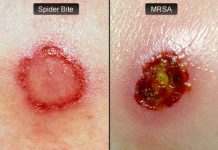 What is MRSA Staph Infection