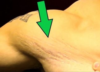 how to get rid of stretch marks for men male
