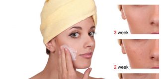 How to Avoid Acne Scars Naturally