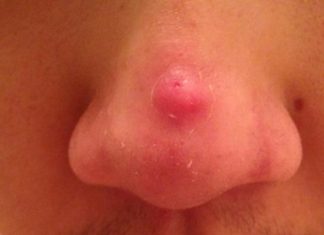 How to get rid of pimple on nose