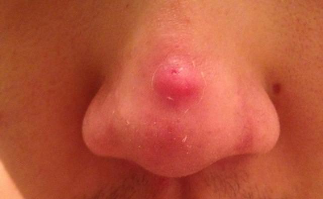 How To Get Rid Of Pimples On Nose Fast And Overnight