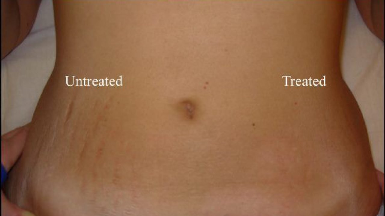 tazorac gel for stretch marks