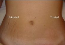 How to get rid of stretch marks - stretch mark removal