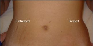 How to get rid of stretch marks - stretch mark removal