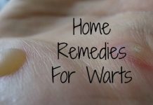 Home Remedies to Get Rid of Warts Naturally Fast Permanently