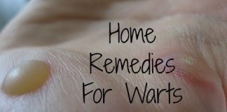 Home Remedies to Get Rid of Warts Naturally Fast Permanently