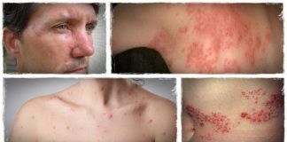 Shingles Treatment Home Remedies for Shingles Pain Relief