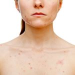 Get Rid of Chest Acne Home Remedies for Chest Acne