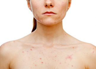 Get Rid of Chest Acne Home Remedies for Chest Acne