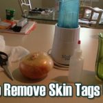 Home Remedies for Skin Tag Removal Naturally