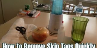 Home Remedies for Skin Tag Removal Naturally