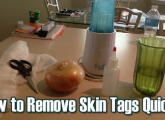 Home Remedies for Skin Tag Removal Naturally