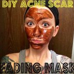 Home Remedies to Fade Acne Scars Erase Acne Scars at Home