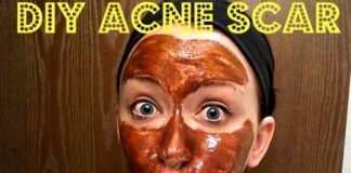 Home Remedies to Fade Acne Scars Erase Acne Scars at Home
