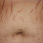 Remove Stretch Marks Fast and Naturally Home Remedies