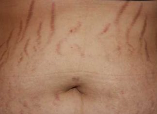 Remove Stretch Marks Fast and Naturally Home Remedies