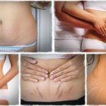 Home Remedies For Stretch Marks Removal Naturally at Home