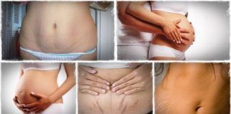 Home Remedies For Stretch Marks Removal Naturally at Home