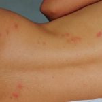 How to Treat Bed Bug Bites