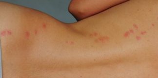 How to Treat Bed Bug Bites