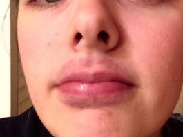 How to get rid of a bruised lips swollen lips