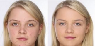 Home Remedies for Acne and Acne Scars Treatment