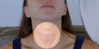 Home Remedies for Goiter Treatment Naturally