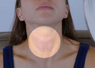 Home Remedies for Goiter Treatment Naturally