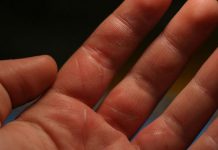 How to Treat Burn Naturally and Easily