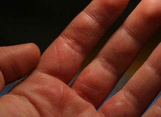 How to Treat Burn Naturally and Easily
