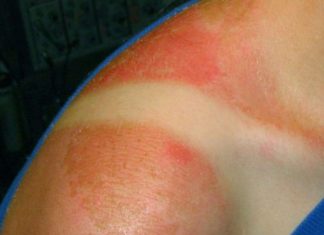 How to Treat a Sunburn and Get Sunburn Relief