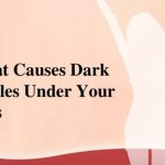 What causes dark circles under eyes bags