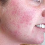 Home Remedies To Treat Rashes On Face