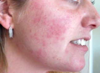 Home Remedies To Treat Rashes On Face