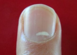 Home Remedies To Treat White Spots On Nails