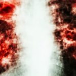 Home Remedies to Treat Pulmonary Fibrosis Disorder