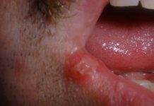 How to Get Rid of Cold Sores and Fiver Blisters