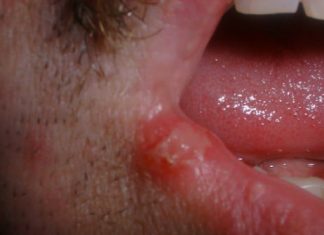 How to Get Rid of Cold Sores and Fiver Blisters