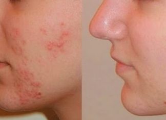 How to Heal Acne Fast and Naturally