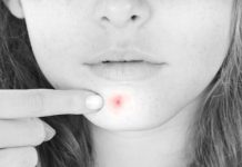 how to reduce pimple redness reduce redness of a pimple