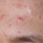 how to prevent pimples stop pimples from coming back