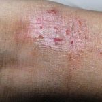 Home Remedies for Body Rashes and Allergies Treatment