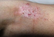 Home Remedies for Body Rashes and Allergies Treatment