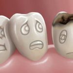 Home Remedies for Cavities Pain and Tooth Decay