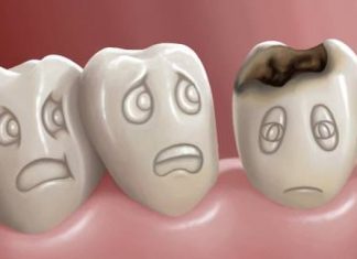 Home Remedies for Cavities Pain and Tooth Decay