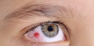 Home Remedies for Eye Infection Treatment
