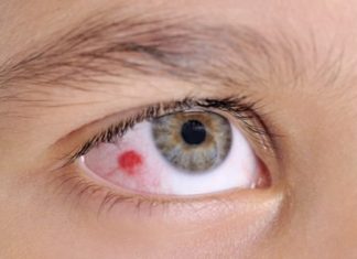 Home Remedies for Eye Infection Treatment
