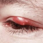 how to get rid of a stye overnight fast naturally